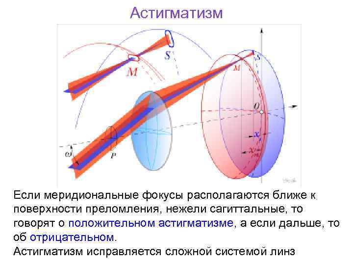 Астигматизм Если меридиональные фокусы располагаются ближе к поверхности преломления, нежели сагиттальные, то говорят о