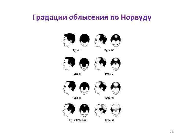 Градации облысения по Норвуду 74 