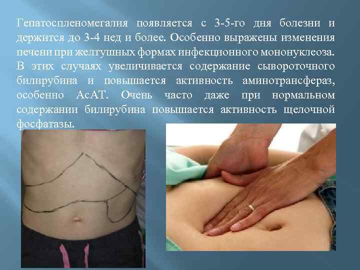 Гепатоспленомегалия появляется с 3 -5 -го дня болезни и держится до 3 -4 нед