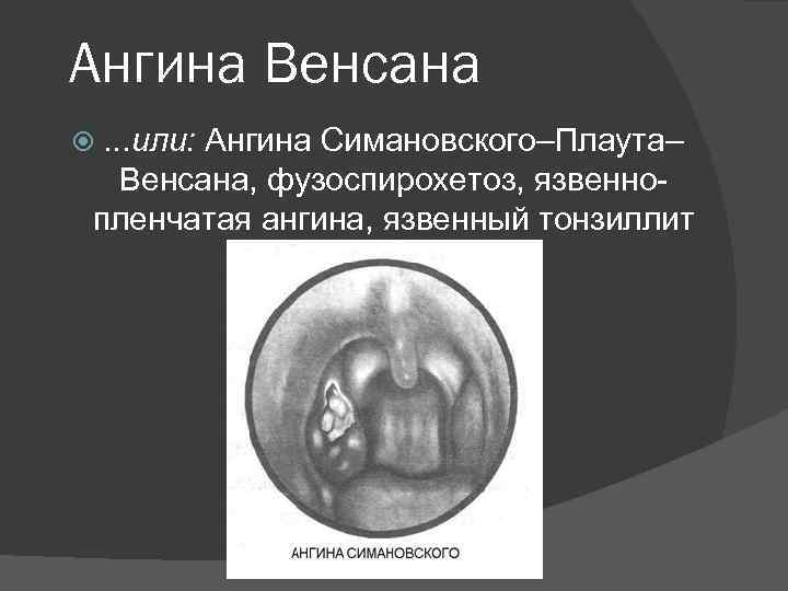 Ангина Венсана. . . или: Ангина Симановского–Плаута– Венсана, фузоспирохетоз, язвеннопленчатая ангина, язвенный тонзиллит 