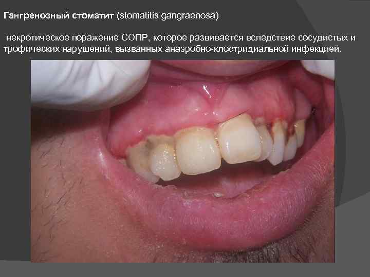 Гангренозный стоматит (stomatitis gangraenosa) некротическое поражение СОПР, которое развивается вследствие сосудистых и трофических нарушений,