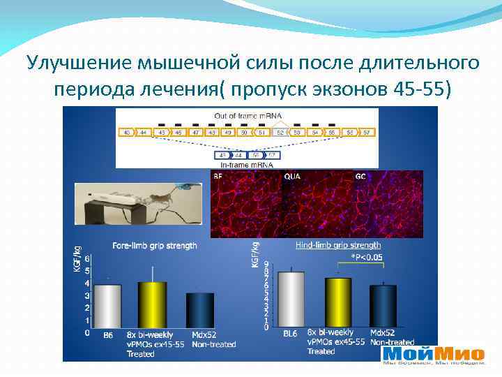 Улучшение мышечной силы после длительного периода лечения( пропуск экзонов 45 -55) 