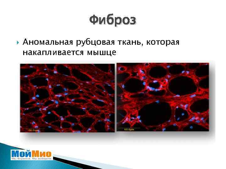 Фиброз Аномальная рубцовая ткань, которая накапливается мышце 