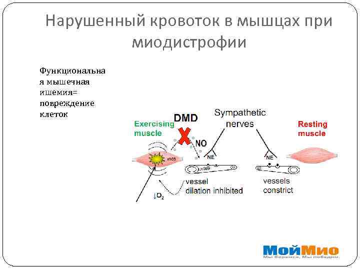 Нарушенный кровоток в мышцах при миодистрофии Функциональна я мышечная ишемия= повреждение клеток 