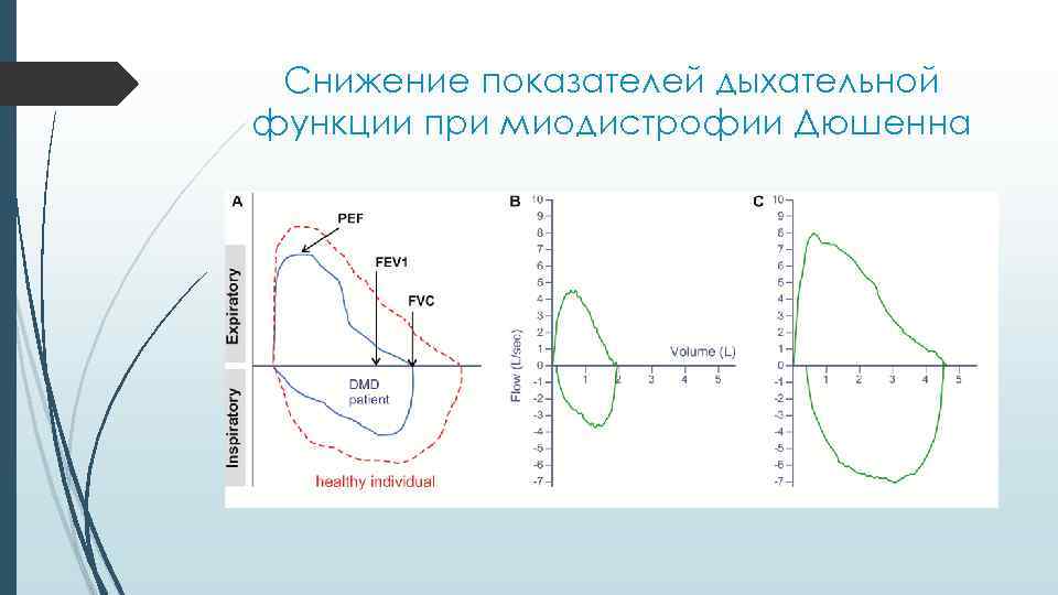 Снижение показателей дыхательной функции при миодистрофии Дюшенна 