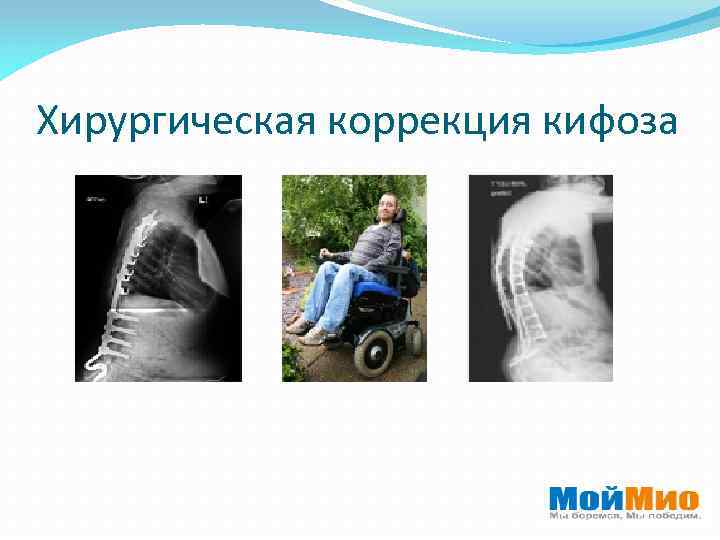 Хирургическая коррекция кифоза 