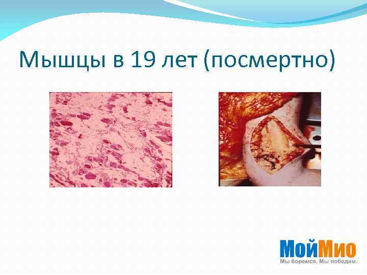 Мышцы в 19 лет (посмертно) 