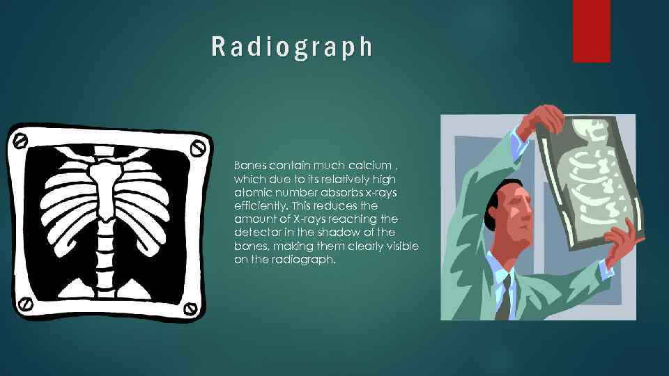 Radiograph Bones contain much calcium , which due to its relatively high atomic number