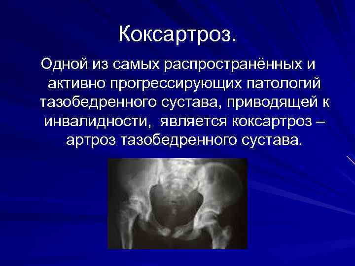 Коксартроз мкб. Коксартроз презентация. Коксартроз тазобедренного сустава инвалидность. Реабилитация коксартроз презентация. Патологии тазобедренного сустава презентация.