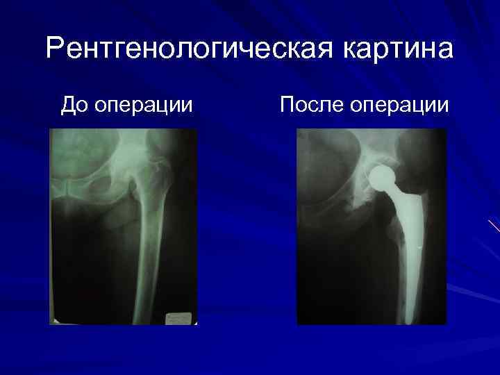 Рентгенологическая картина До операции После операции 