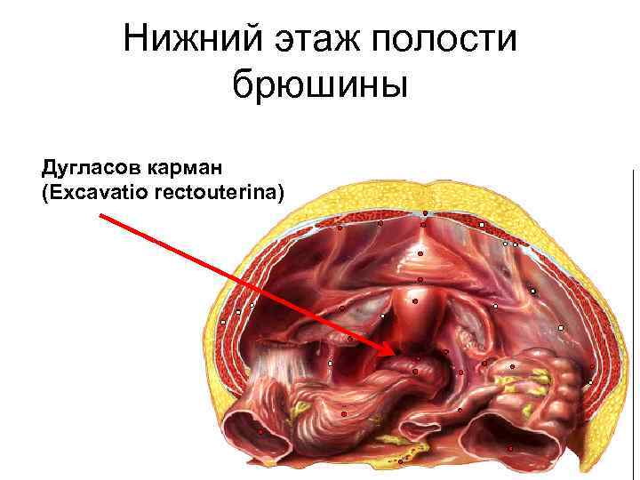 Нижний этаж полости брюшины Дугласов карман (Excavatio rectouterina) 