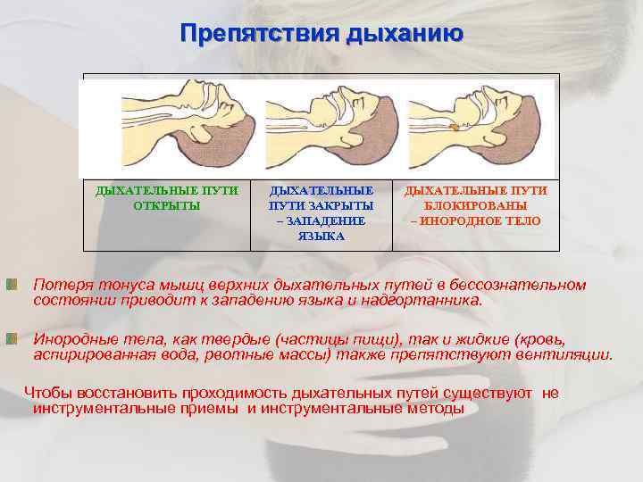 Препятствия дыханию ДЫХАТЕЛЬНЫЕ ПУТИ ОТКРЫТЫ ДЫХАТЕЛЬНЫЕ ПУТИ ЗАКРЫТЫ – ЗАПАДЕНИЕ ЯЗЫКА ДЫХАТЕЛЬНЫЕ ПУТИ БЛОКИРОВАНЫ