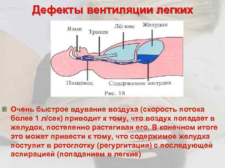 Дефекты вентиляции легких Очень быстрое вдувание воздуха (скорость потока более 1 л/сек) приводит к