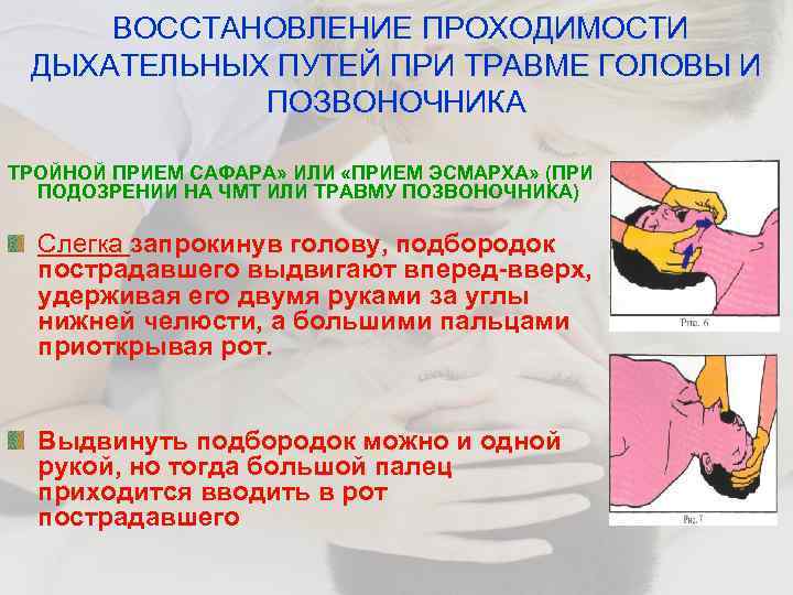 ВОССТАНОВЛЕНИЕ ПРОХОДИМОСТИ ДЫХАТЕЛЬНЫХ ПУТЕЙ ПРИ ТРАВМЕ ГОЛОВЫ И ПОЗВОНОЧНИКА ТРОЙНОЙ ПРИЕМ САФАРА» ИЛИ «ПРИЕМ