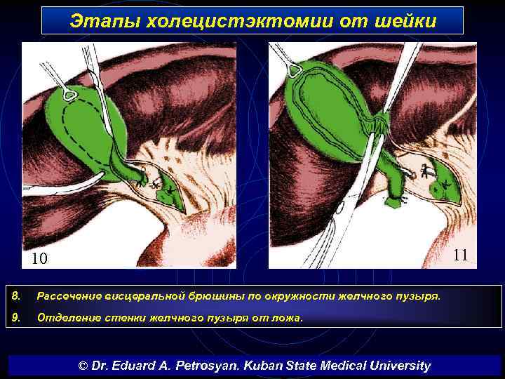 Этапы холецистэктомии от шейки 11 10 8. Рассечение висцеральной брюшины по окружности желчного пузыря.