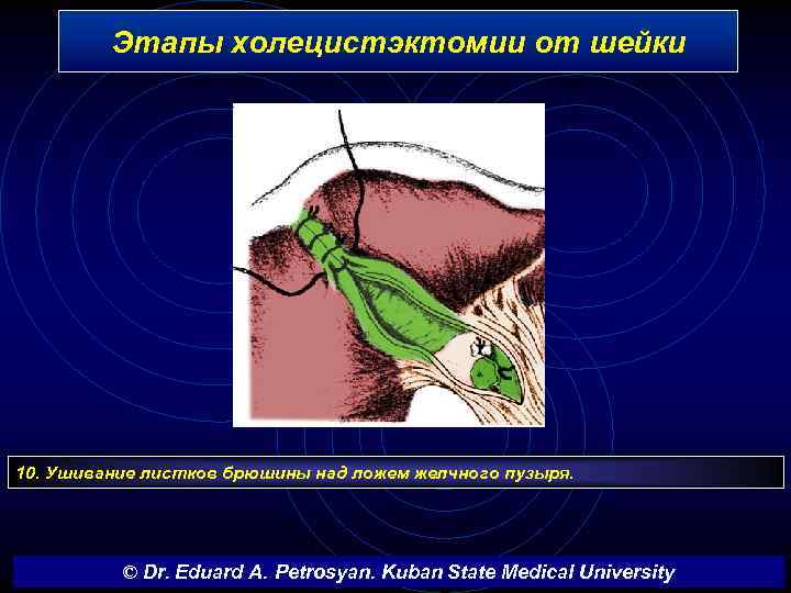 Этапы холецистэктомии от шейки 10. Ушивание листков брюшины над ложем желчного пузыря. © Dr.