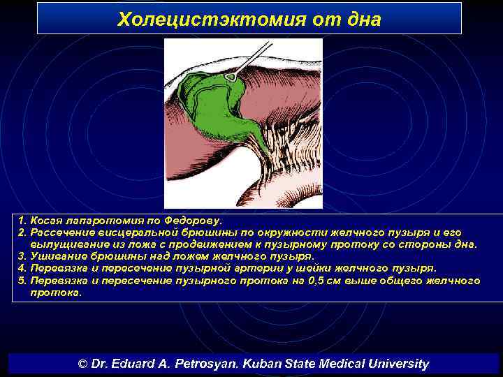 Холецистэктомия от дна 1. Косая лапаротомия по Федорову. 2. Рассечение висцеральной брюшины по окружности