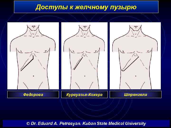 Доступы к желчному пузырю Федорова Курвуазье-Кохера Шпренгеля © Dr. Eduard A. Petrosyan. Kuban State