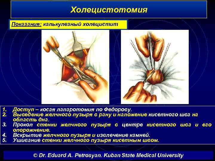 Холецистотомия Показания: калькулезный холецистит 1. 2. 3. 4. 5. Доступ – косая лапаротомия по