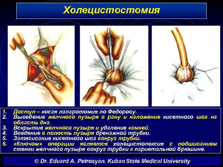 Холецистостомия 1. 2. 3. 4. 5. 6. Доступ – косая лапаротомия по Федорову. Выведение