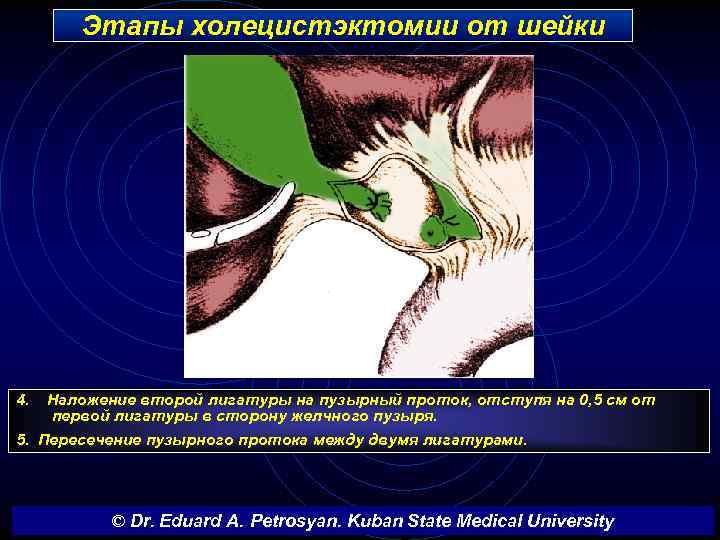 Этапы холецистэктомии от шейки 4. Наложение второй лигатуры на пузырный проток, отступя на 0,