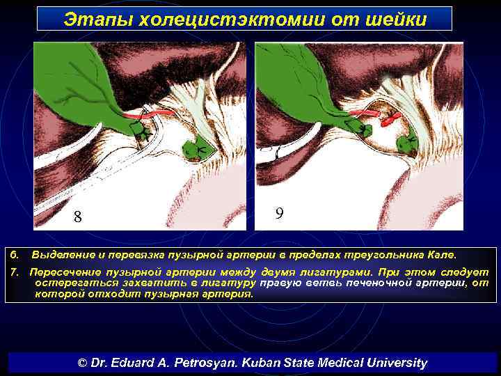 Этапы холецистэктомии от шейки 8 6. 9 Выделение и перевязка пузырной артерии в пределах