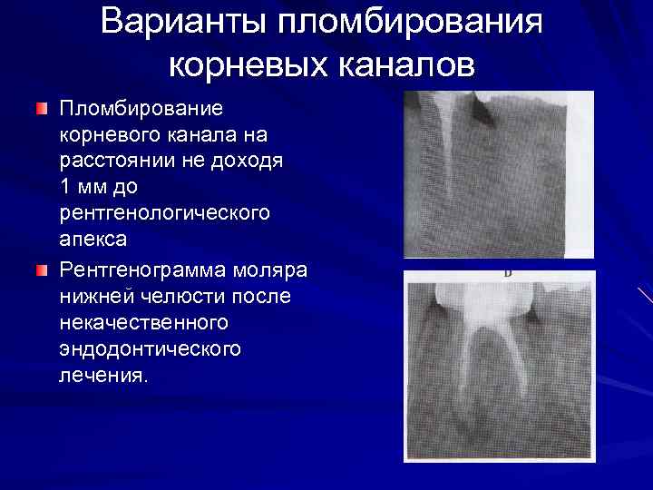 Пломбирование каналов презентация