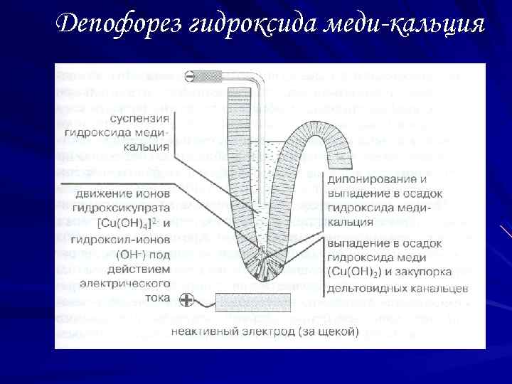 Депофорез гидроксида меди-кальция 