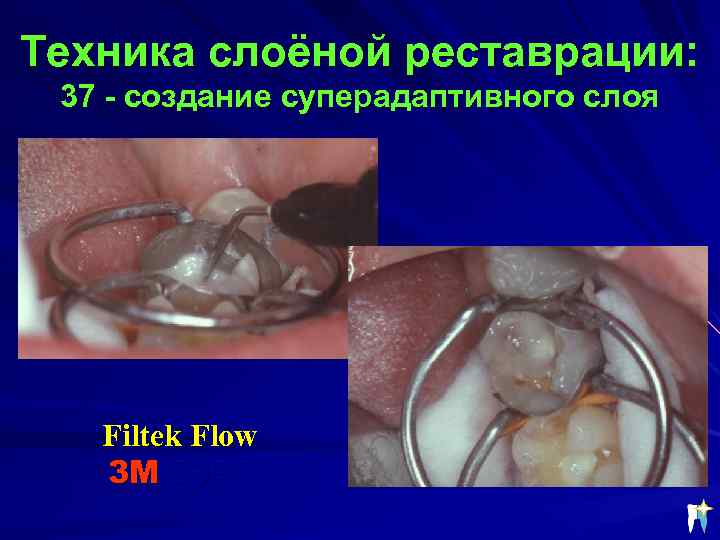 Техника слоёной реставрации: 37 - создание суперадаптивного слоя Filtek Flow 3 М ESPE 