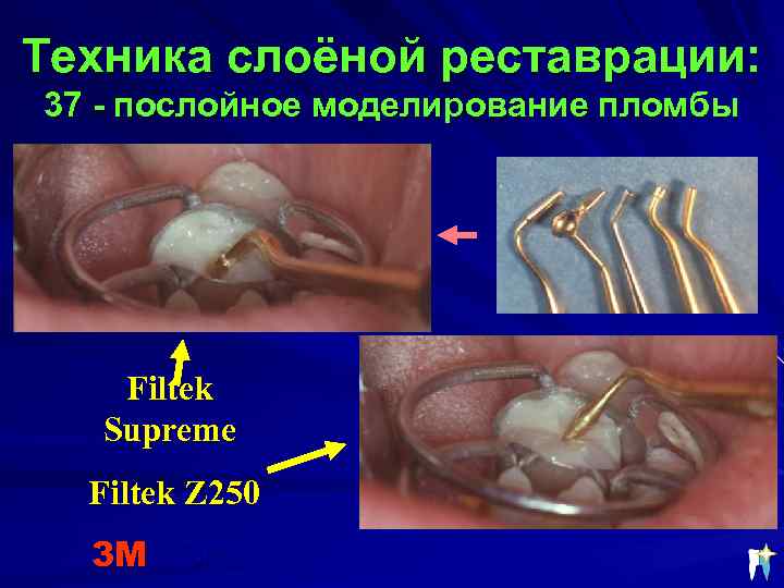 Техника слоёной реставрации: 37 - послойное моделирование пломбы Filtek Supreme Filtek Z 250 3