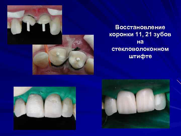 Восстановление коронки 11, 21 зубов на стекловолоконном штифте 