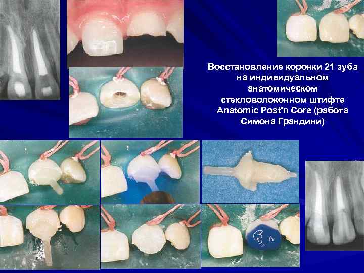 Восстановление коронки 21 зуба на индивидуальном анатомическом стекловолоконном штифте Anatomic Post'n Core (работа Симона