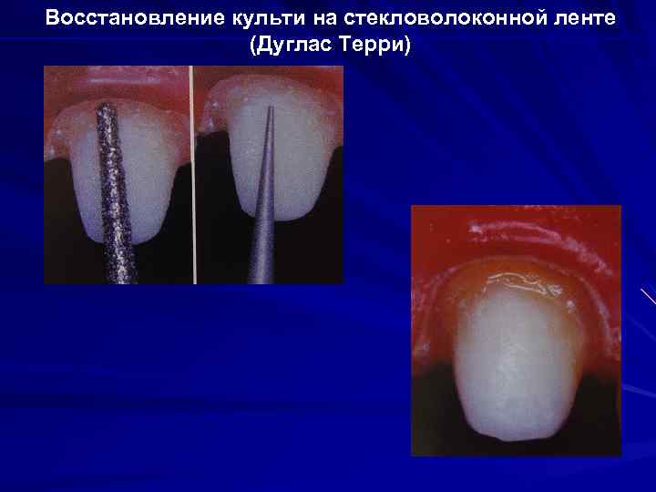 Восстановление культи на стекловолоконной ленте (Дуглас Терри) 