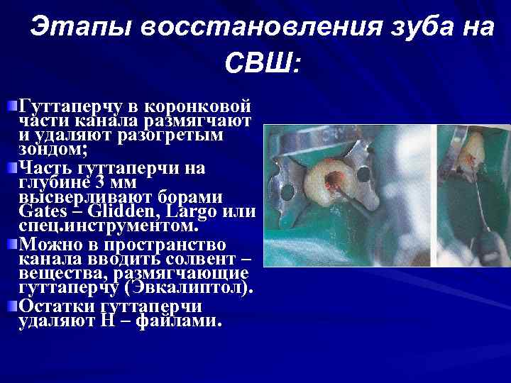 Этапы восстановления зуба на СВШ: Гуттаперчу в коронковой части канала размягчают и удаляют разогретым