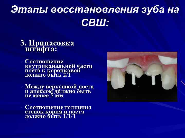 Этапы восстановления зуба на СВШ: 3. Припасовка штифта: - Соотношение внутриканальной части поста к