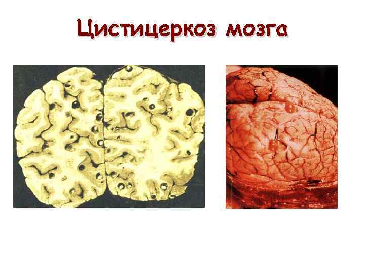 Цистицеркоз мозга 