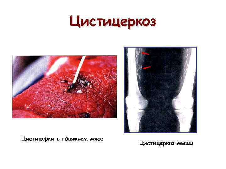 Цистицеркоз Цистицерки в говяжьем мясе Цистицеркоз мышц 