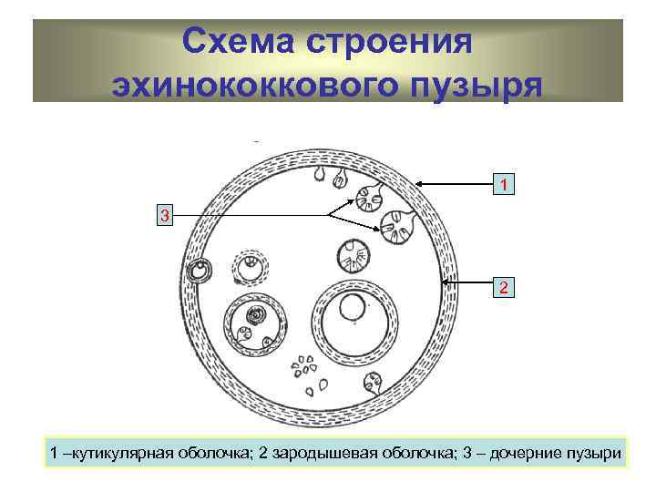 Схема эхинококковой кисты