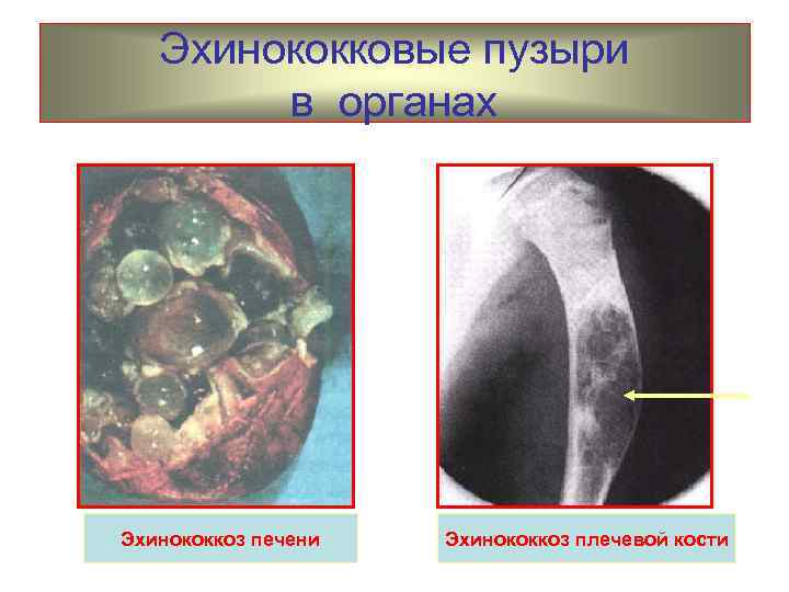 Эхинококковые пузыри в органах Эхинококкоз печени Эхинококкоз плечевой кости 