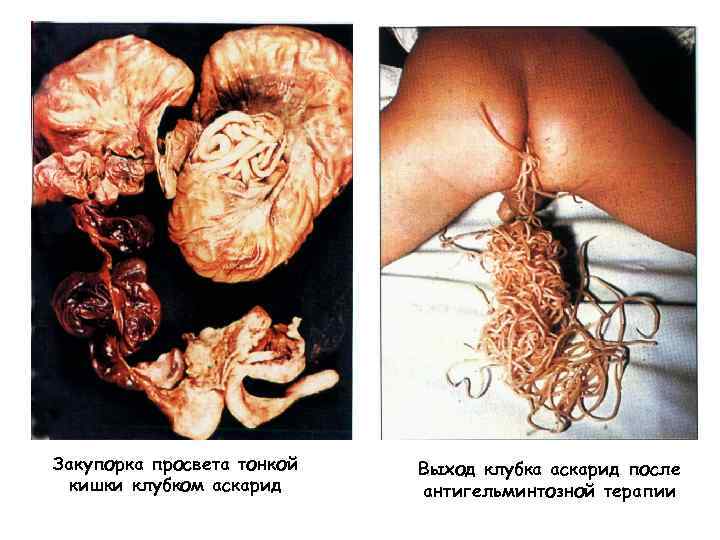 Закупорка просвета тонкой кишки клубком аскарид Выход клубка аскарид после антигельминтозной терапии 