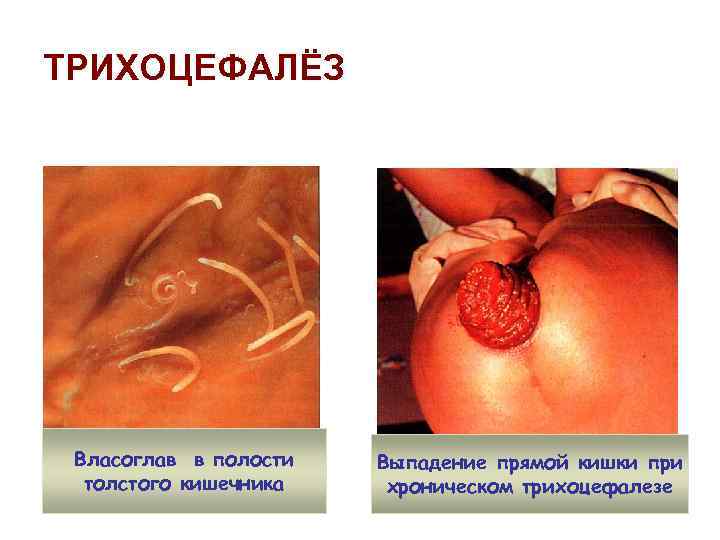 ТРИХОЦЕФАЛЁЗ Власоглав в полости толстого кишечника Выпадение прямой кишки при хроническом трихоцефалезе 
