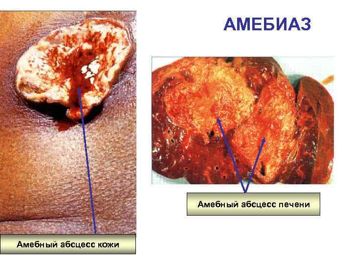 АМЕБИАЗ Амебный абсцесс печени Амебный абсцесс кожи 