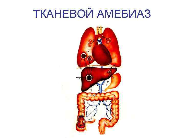 ТКАНЕВОЙ АМЕБИАЗ 