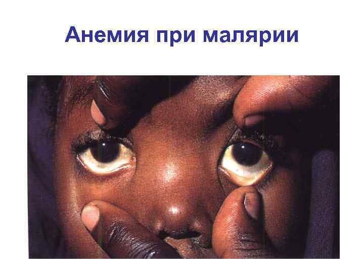 Анемия при малярии 