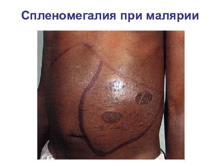 Спленомегалия при малярии 