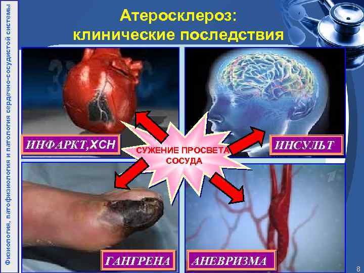 Физиология, патофизиология и патология сердечно-сосудистой системы Атеросклероз: клинические последствия ИНФАРКТ, ХСН СУЖЕНИЕ ПРОСВЕТА СОСУДА