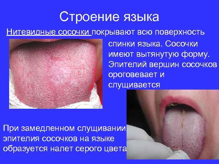 Строение языка Нитевидные сосочки покрывают всю поверхность спинки языка. Сосочки имеют вытянутую форму. Эпителий