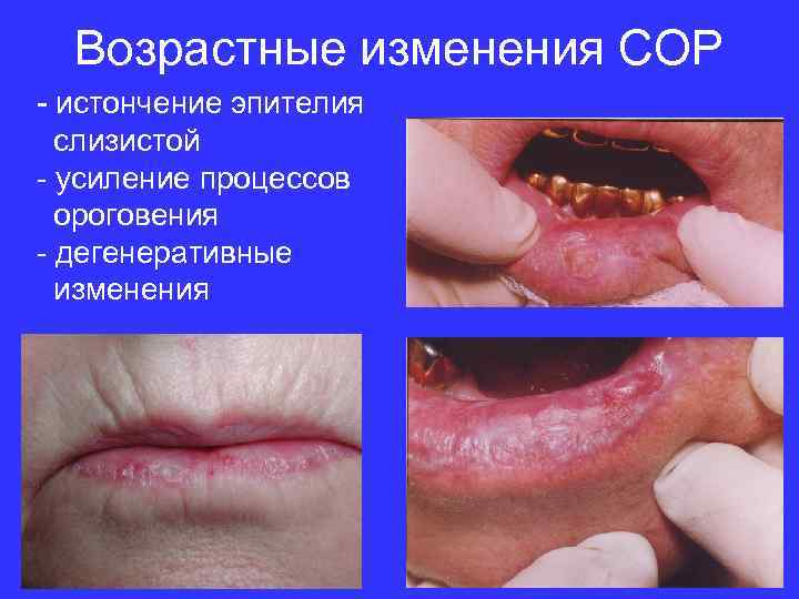Возрастные изменения СОР - истончение эпителия слизистой - усиление процессов ороговения - дегенеративные изменения