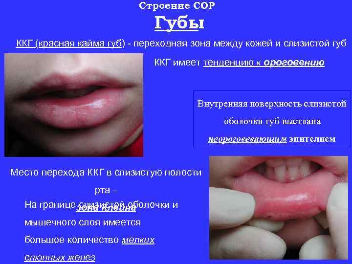 Строение СОР Губы ККГ (красная кайма губ) - переходная зона между кожей и слизистой