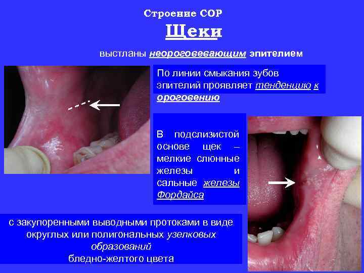 Строение СОР Щеки выстланы неороговевающим эпителием По линии смыкания зубов эпителий проявляет тенденцию к